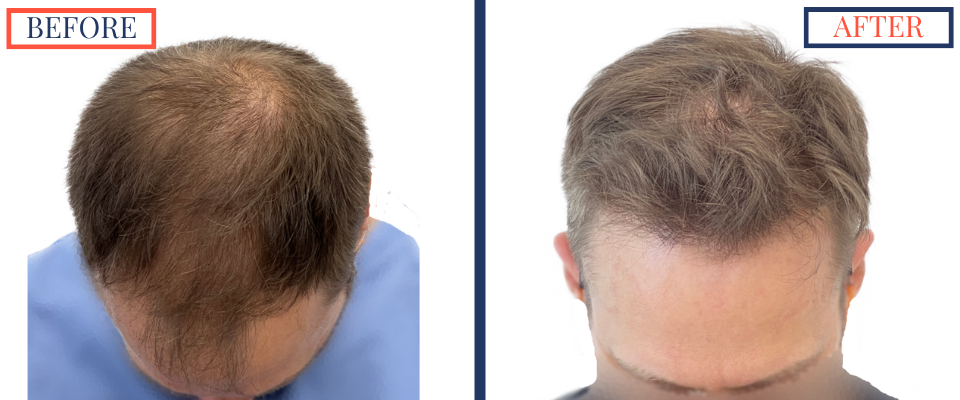 2415 Graft FUE Hair Transplant Result - Top Front chin down view before and after
