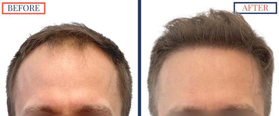 2415 Graft FUE Hair Transplant Result - Front view before and after
