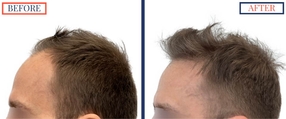 2415 Graft FUE Hair Transplant Result - Left profile view before and after