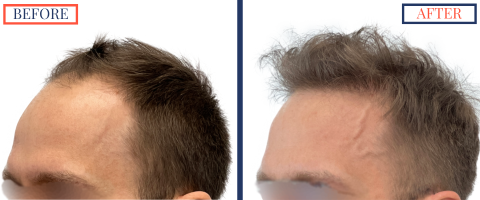 2415 Graft FUE Hair Transplant Result - Left oblique view before and after