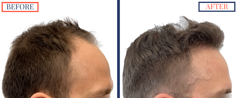 2415 Graft FUE Hair Transplant Result - Right profile view before and after