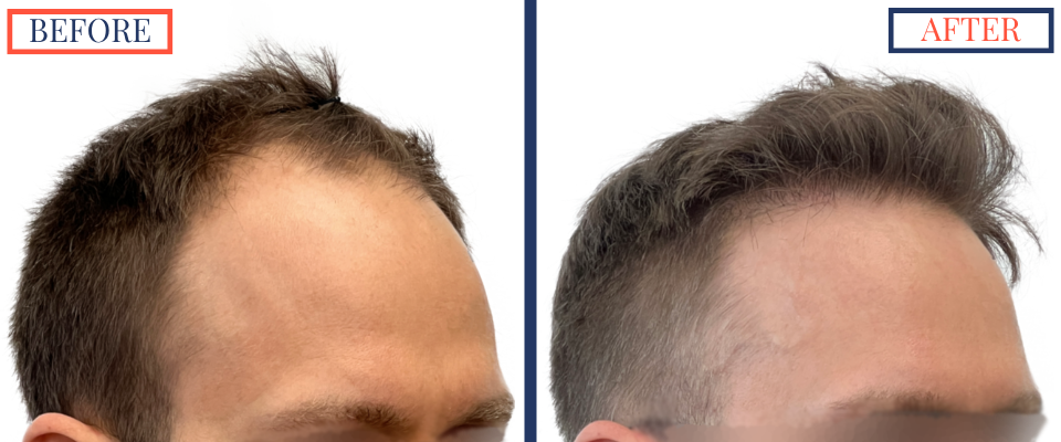 2415 Graft FUE Hair Transplant Result - Right oblique view before and after