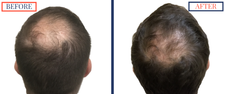 2400 GRAFT FUE HAIR TRANSPLANT RESULTS