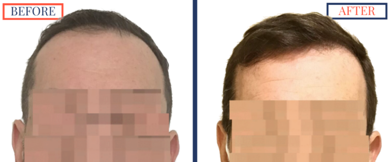2400 GRAFT FUE HAIR TRANSPLANT RESULTS