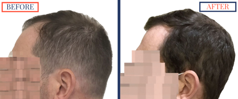 2400 GRAFT FUE HAIR TRANSPLANT RESULTS