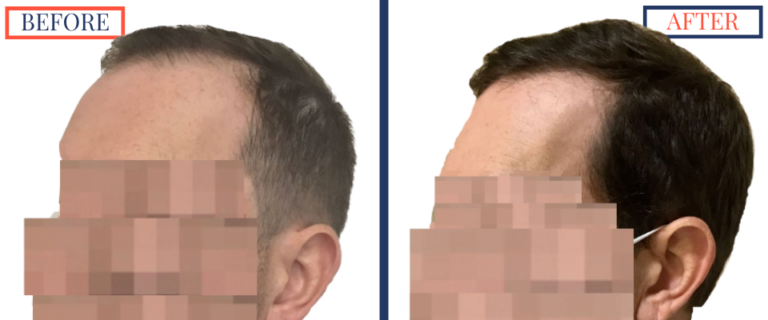 2400 GRAFT FUE HAIR TRANSPLANT RESULTS