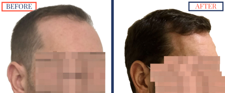 2400 GRAFT FUE HAIR TRANSPLANT RESULTS