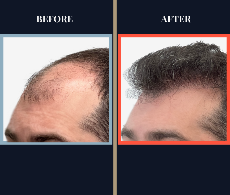 Before and After - 2601 GRAFT FUE HAIR TRANSPLANT