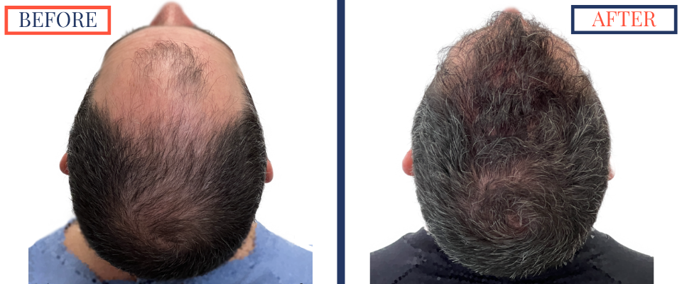 Before and After - 2601 GRAFT FUE HAIR TRANSPLANT