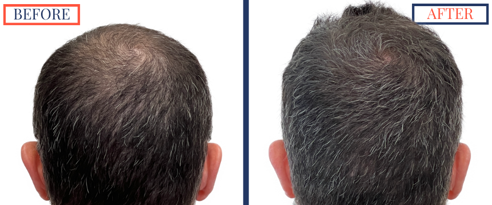 Before and After - 2601 GRAFT FUE HAIR TRANSPLANT