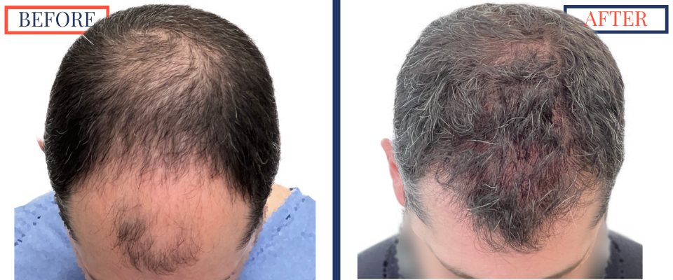 Before and After - 2601 GRAFT FUE HAIR TRANSPLANT