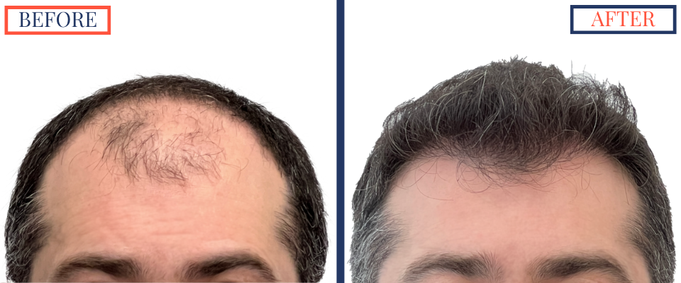Before and After - 2601 GRAFT FUE HAIR TRANSPLANT