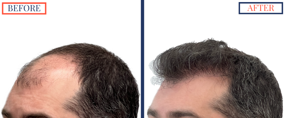 Before and After - 2601 GRAFT FUE HAIR TRANSPLANT