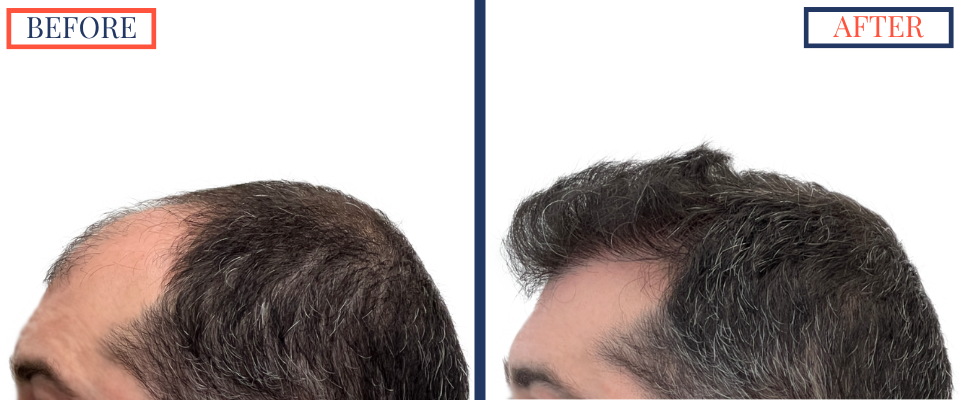 Before and After - 2601 GRAFT FUE HAIR TRANSPLANT