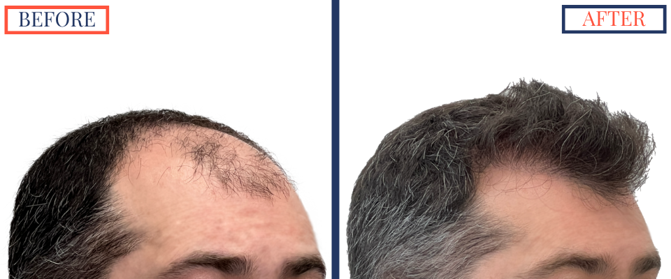 Before and After - 2601 GRAFT FUE HAIR TRANSPLANT
