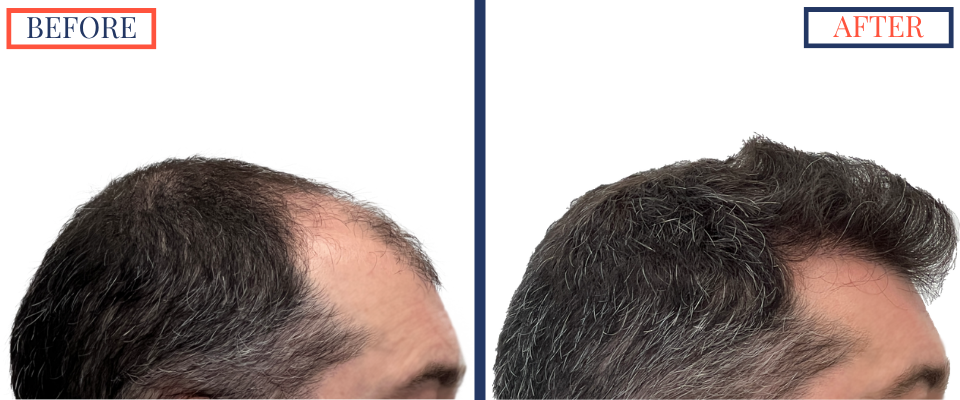 Before and After - 2601 GRAFT FUE HAIR TRANSPLANT