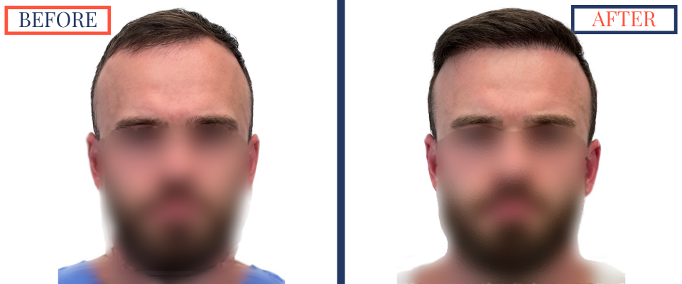 Before and After FUE Hair Transplant Result - 2731 grafts one year post-op