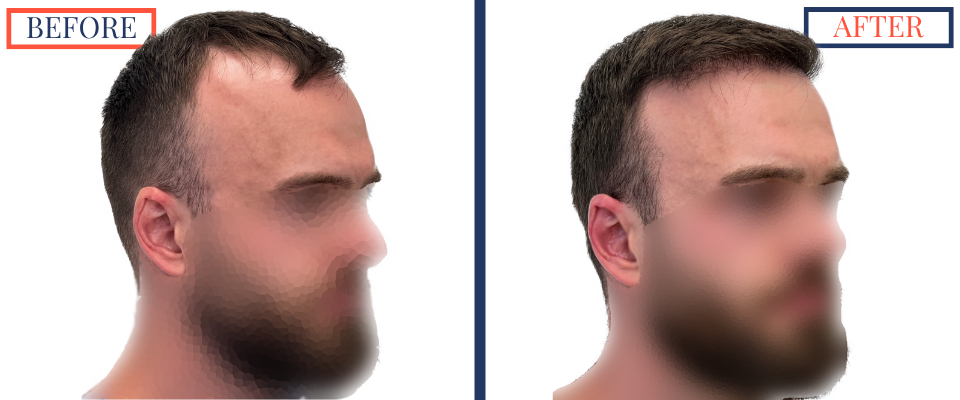 Before and After FUE Hair Transplant Result - 2731 grafts one year post-op