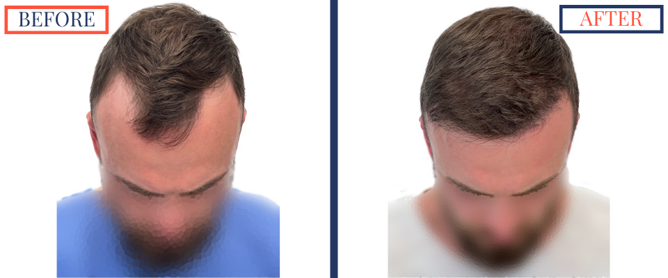 Before and After FUE Hair Transplant Result - 2731 grafts one year post-op