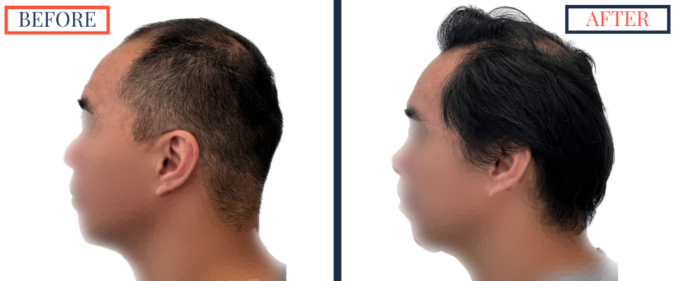 2104 GRAFT FUE HAIR TRANSPLANT RESULT PHOTO
