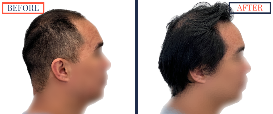 2104 GRAFT FUE HAIR TRANSPLANT RESULT PHOTO