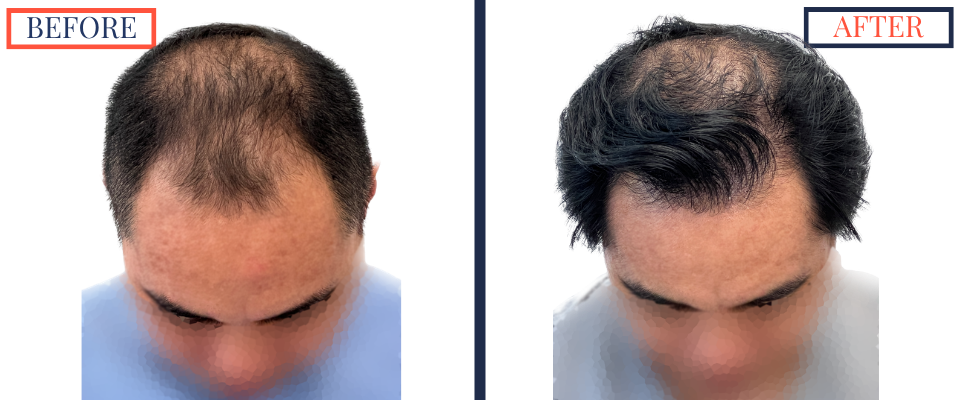 2104 GRAFT FUE HAIR TRANSPLANT RESULT PHOTO